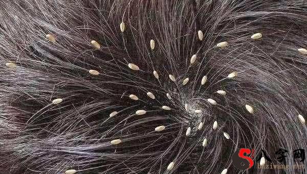 梦见小孩身上好多虱子