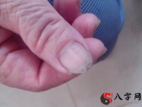 梦见指甲里面拽出虫子